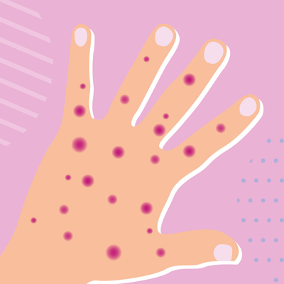 Kit de test en temps réel PCR Monkeypox pour maladies infectieuses MPXV CE enregistré 1 test/boîte